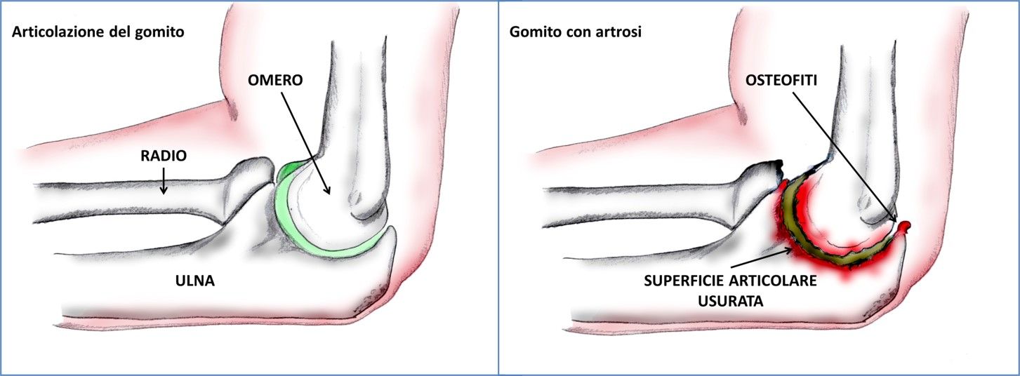 Gomito Rigido Artrosico