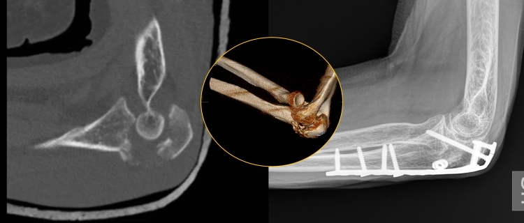 Gomito Frattura Ulna T-SHEL
