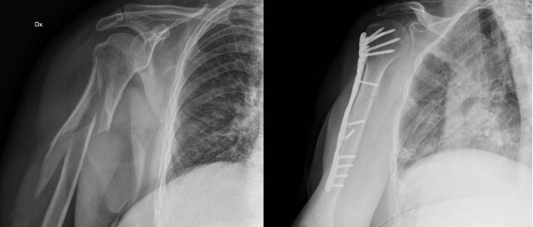 Trauma Spalla Fratture Diafisarie di Omero T-SHEL