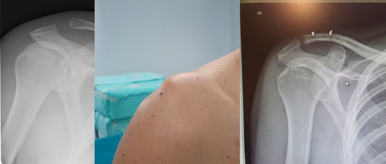 Trauma Spalla Lussazione Acromion-Claveare T-SHEL