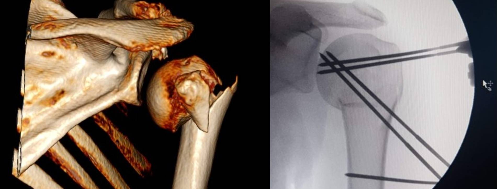 Turin - Shoulder and Elbow Advanced Reconstruction